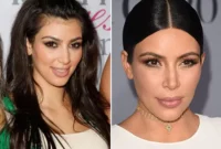 Unlock Kim K’s Smooth Skin Secret: Advanced Laser Hair Removal